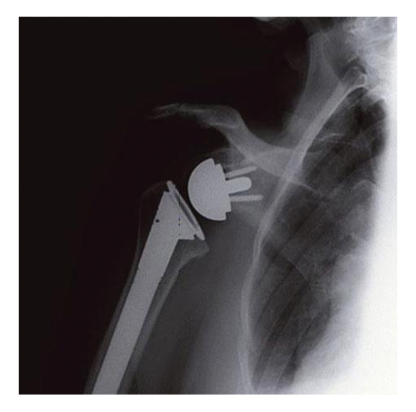 Higher readmission rates experienced after reverse total shoulder arthroplasty